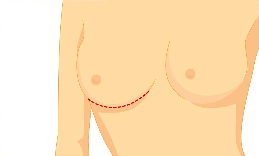 乳房下縁切開