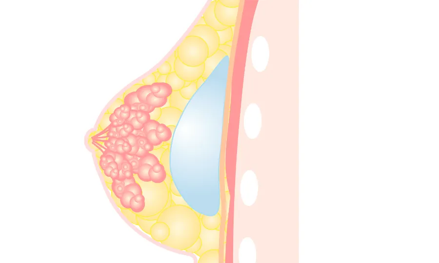 乳腺下法