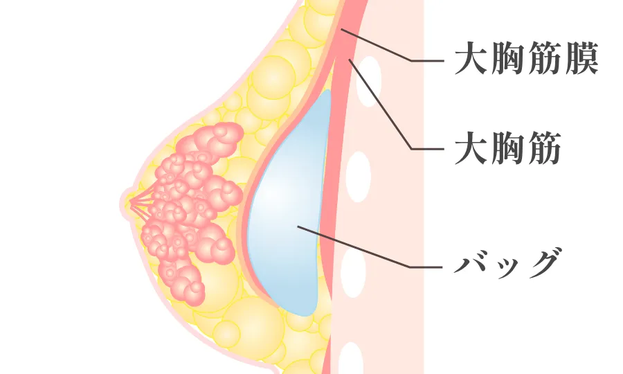 大胸筋下法