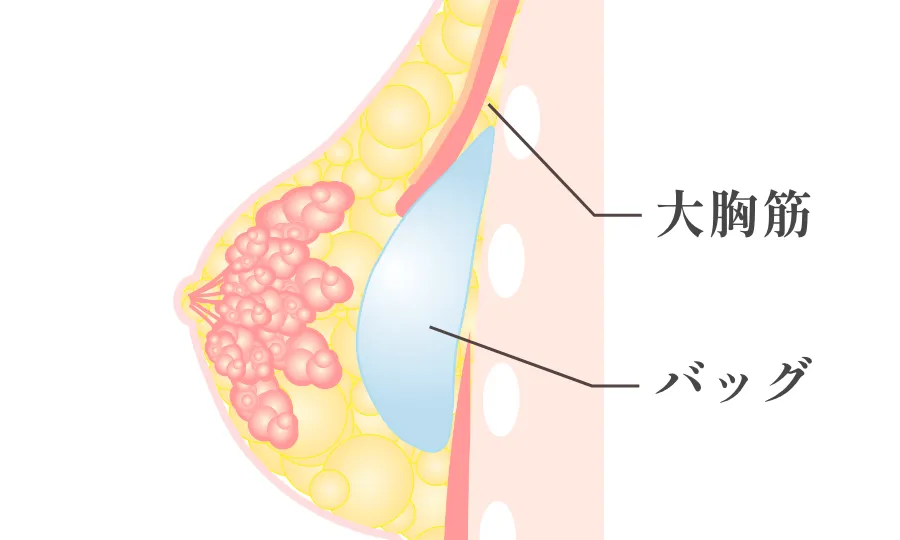 デュアルプレーン法