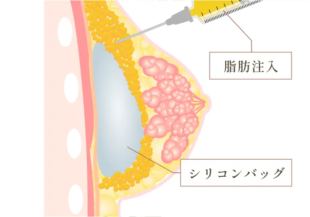 ハイブリッド豊胸