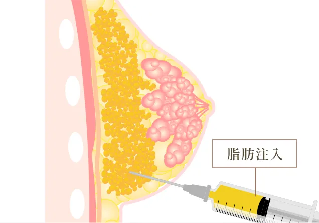 脂肪注入豊胸