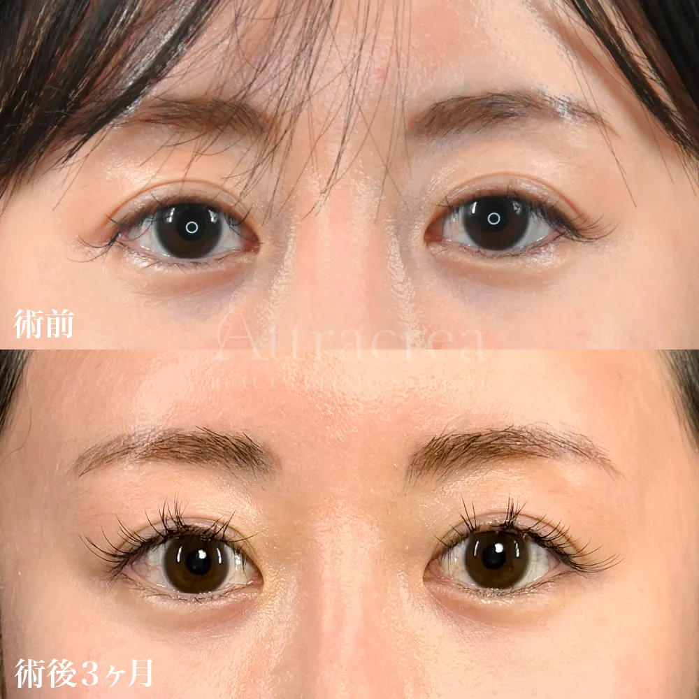 021 切らない眼瞼下垂 埋没法の症例写真