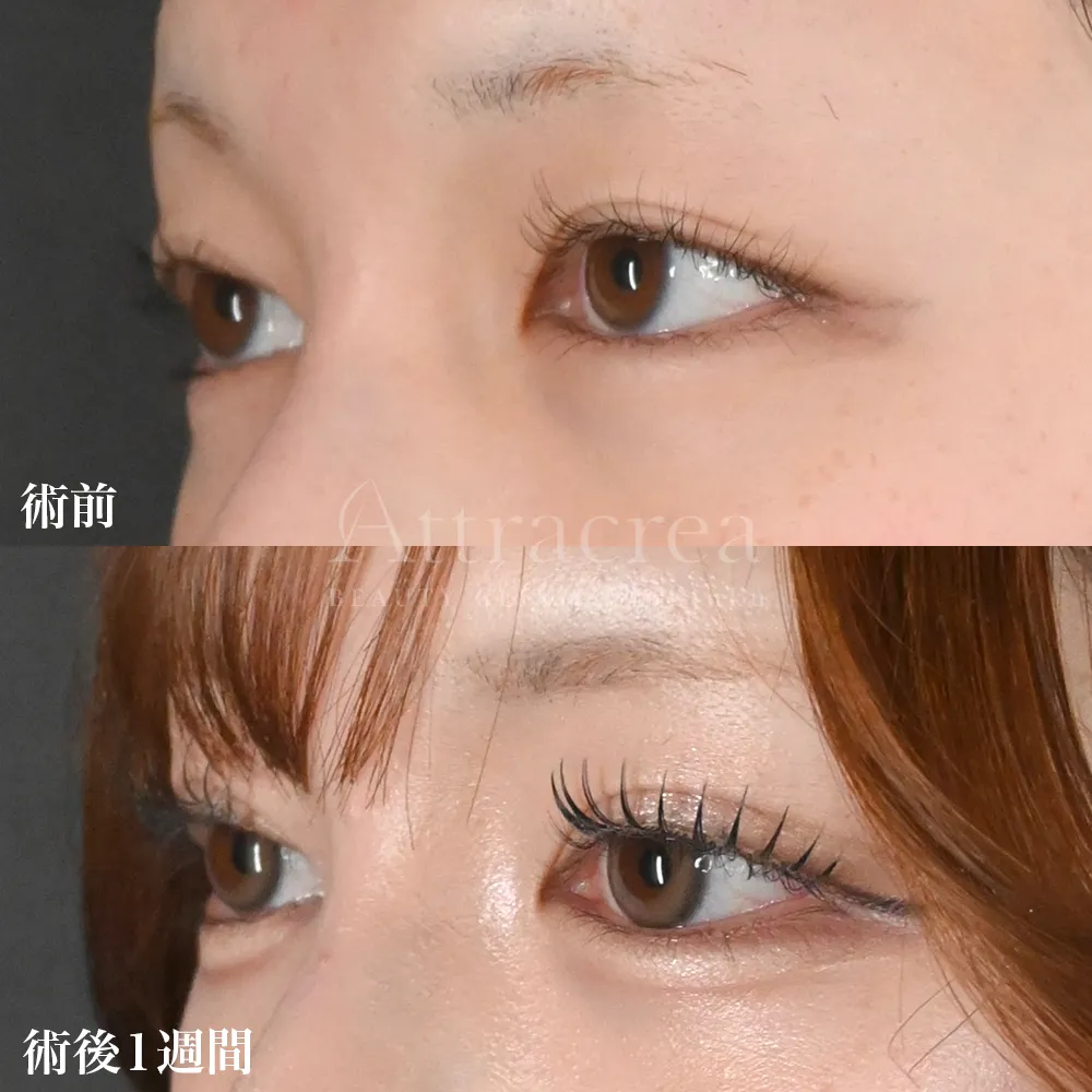 022 二重埋没 ハイブリッド5点留めの症例写真