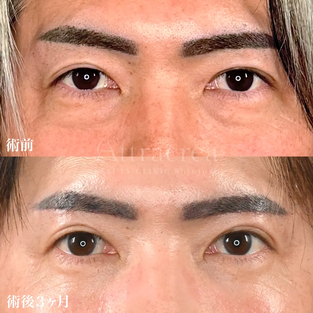 024 裏ハムラ＋眉下切開＋ソフウェーブ全顔の症例写真