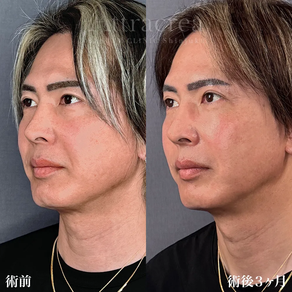 024 裏ハムラ＋眉下切開＋ソフウェーブ全顔の症例写真