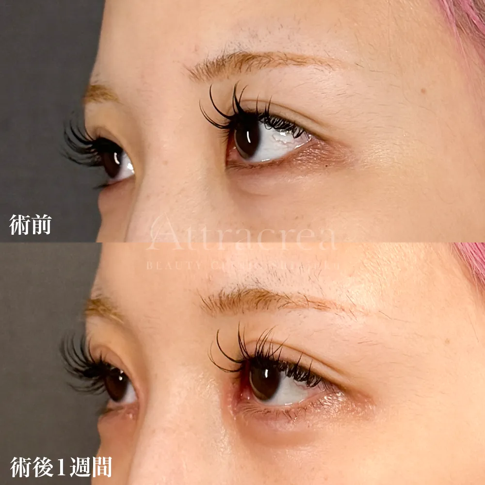 030 目頭切開の症例写真
