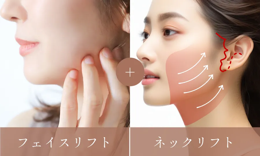 フェイスリフト+ネックリフト