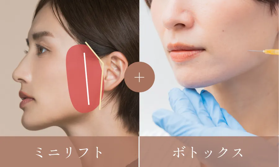 ミニリフト+ボトックス