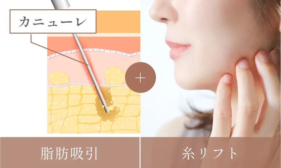 フェイスリフト+ネックリフト