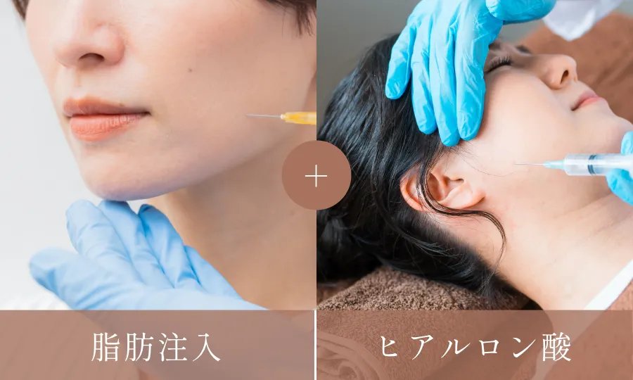 ミニリフト+ボトックス