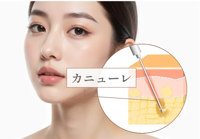 顔の脂肪吸引と脂肪注入