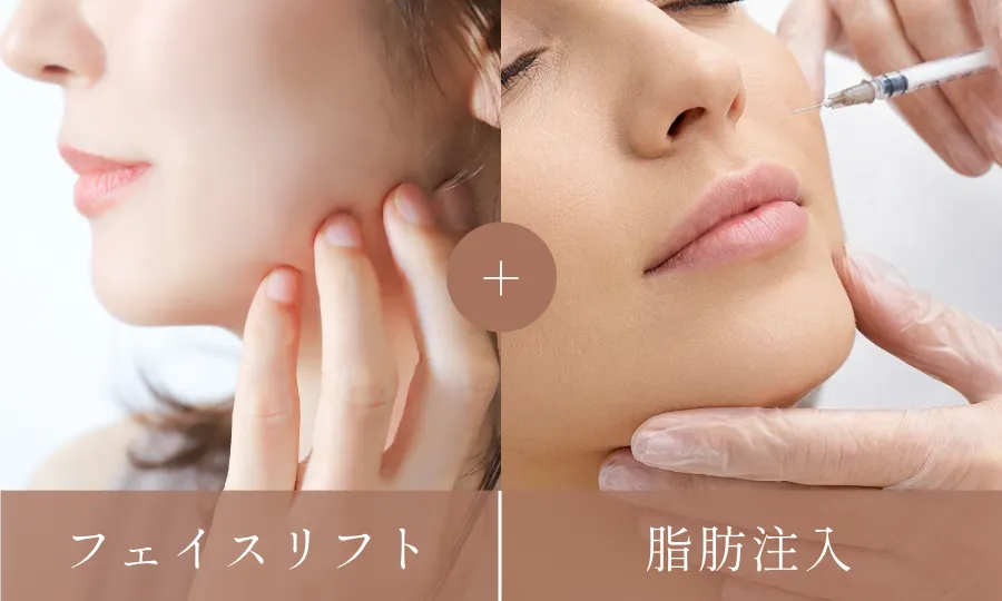 フェイスリフト+脂肪注入