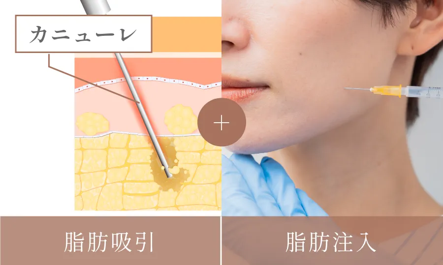 脂肪吸引+脂肪注入