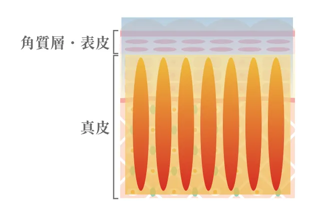 二重全切開法