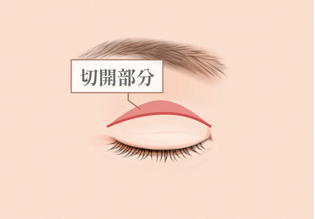 二重全切開法