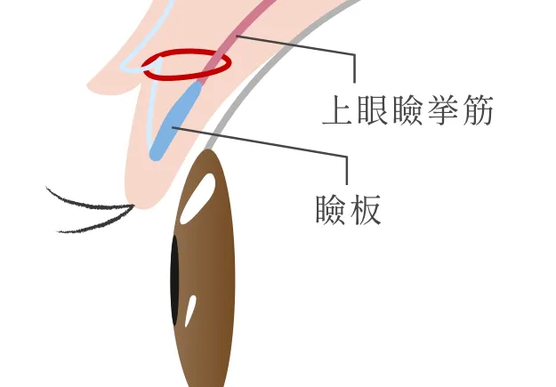 瞼板法