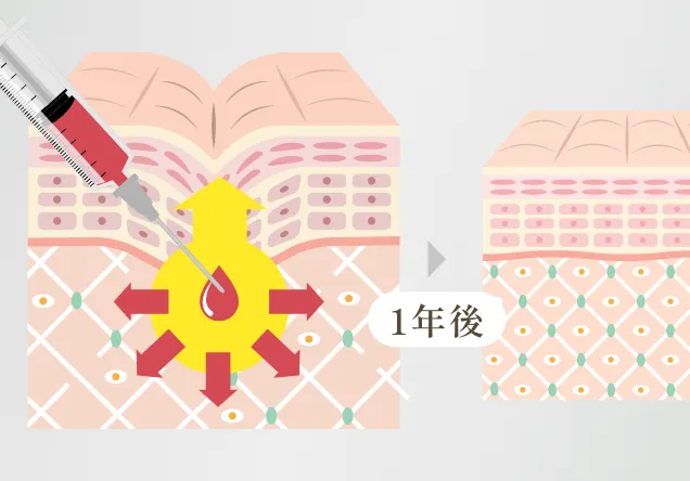 PRP(多血小板血漿)療法