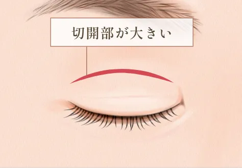 全切開法