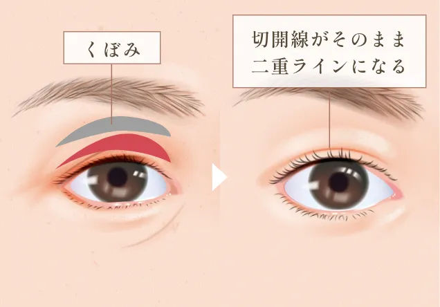 目の上切開(重瞼線切開)