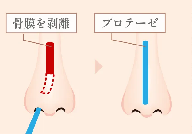 隆鼻術(プロテーゼ)