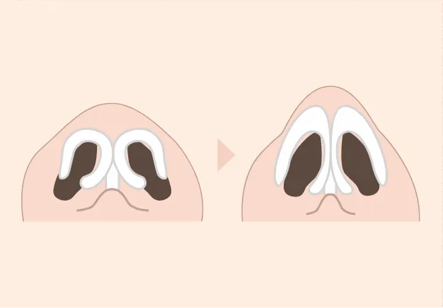 鼻尖形成術・鼻尖縮小術