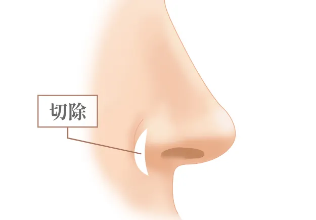 鼻翼縮小術(小鼻縮小)