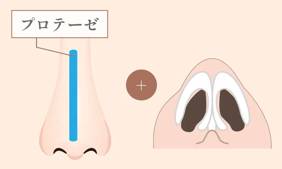 隆鼻術 + 鼻尖形成