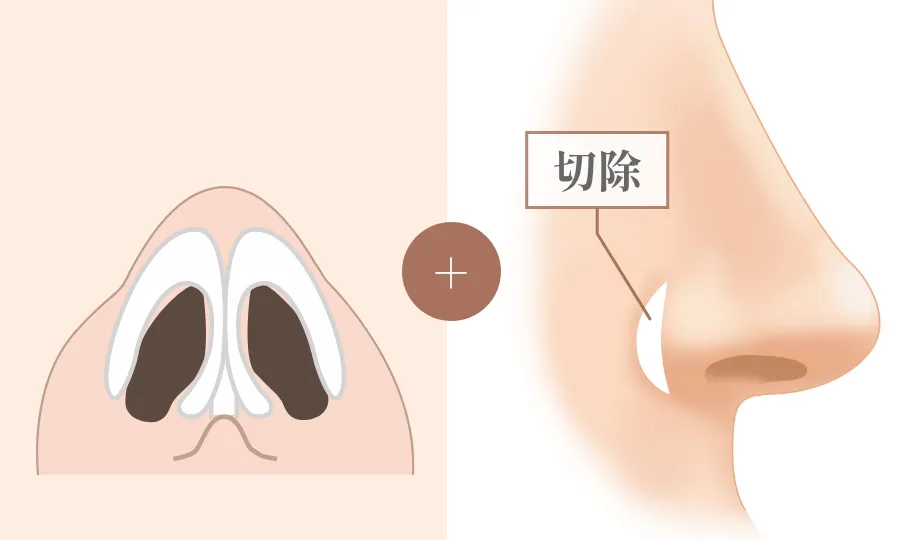 鼻尖形成 + 鼻翼縮小