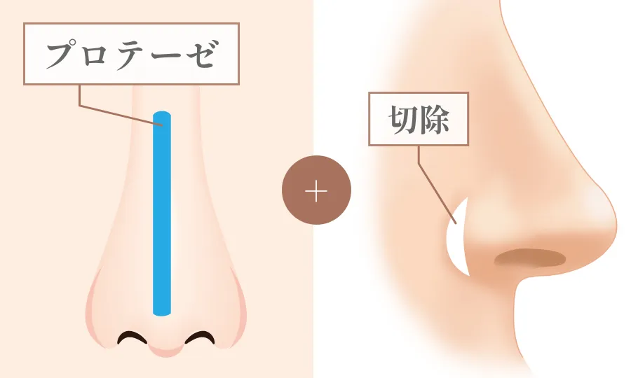 隆鼻術 + 鼻翼縮小
